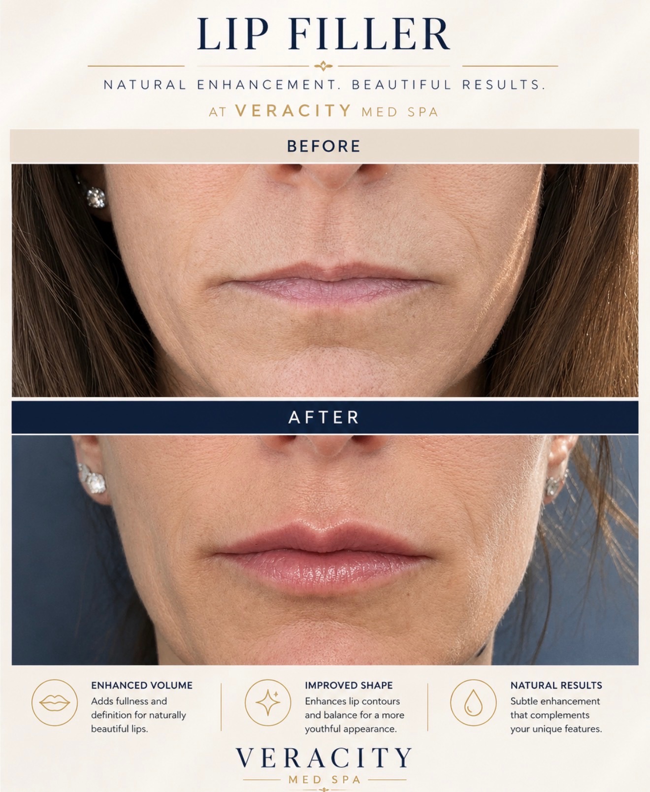 Before and after lip filler treatment at Veracity Med Spa showing natural enhancement and improved lip contours